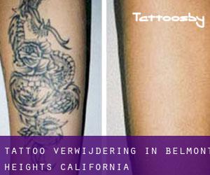 Tattoo verwijdering in Belmont Heights (California)