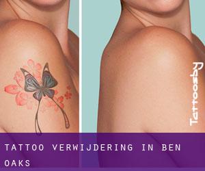 Tattoo verwijdering in Ben Oaks