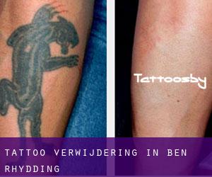 Tattoo verwijdering in Ben Rhydding