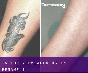 Tattoo verwijdering in Benamejí