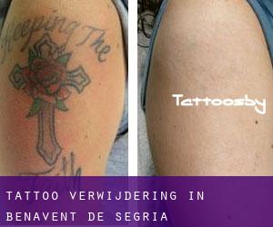 Tattoo verwijdering in Benavent de Segrià