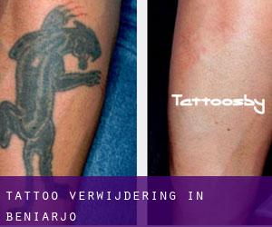 Tattoo verwijdering in Beniarjó