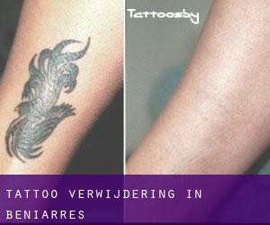 Tattoo verwijdering in Beniarrés