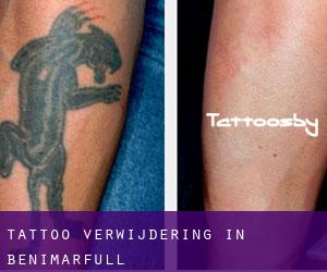 Tattoo verwijdering in Benimarfull