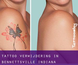 Tattoo verwijdering in Bennettsville (Indiana)
