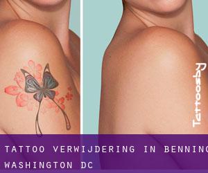 Tattoo verwijdering in Benning (Washington, D.C.)