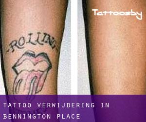 Tattoo verwijdering in Bennington Place