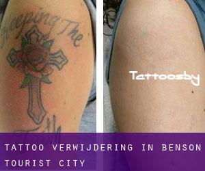 Tattoo verwijdering in Benson Tourist City