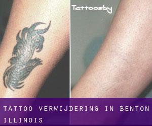 Tattoo verwijdering in Benton (Illinois)