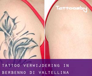 Tattoo verwijdering in Berbenno di Valtellina