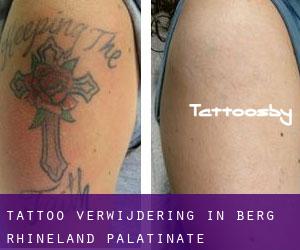 Tattoo verwijdering in Berg (Rhineland-Palatinate)