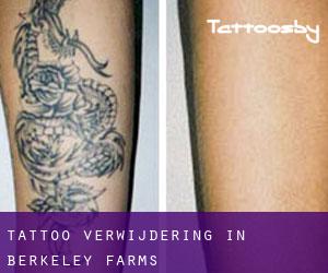 Tattoo verwijdering in Berkeley Farms