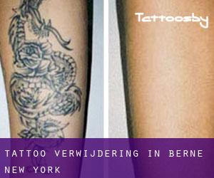 Tattoo verwijdering in Berne (New York)