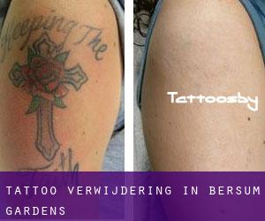Tattoo verwijdering in Bersum Gardens