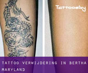 Tattoo verwijdering in Bertha (Maryland)