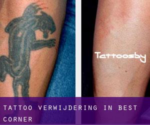 Tattoo verwijdering in Best Corner