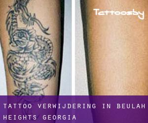 Tattoo verwijdering in Beulah Heights (Georgia)