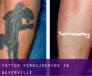 Tattoo verwijdering in Beyerville