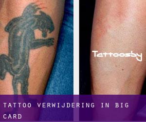 Tattoo verwijdering in Big Card