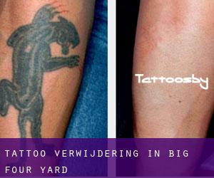 Tattoo verwijdering in Big Four Yard
