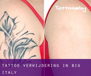 Tattoo verwijdering in Big Italy