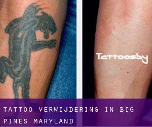 Tattoo verwijdering in Big Pines (Maryland)