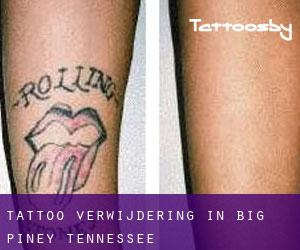 Tattoo verwijdering in Big Piney (Tennessee)