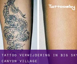 Tattoo verwijdering in Big Sky Canyon Village