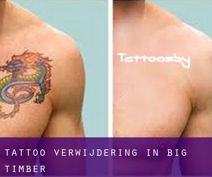 Tattoo verwijdering in Big Timber
