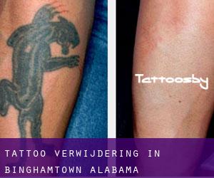 Tattoo verwijdering in Binghamtown (Alabama)