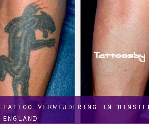 Tattoo verwijdering in Binsted (England)
