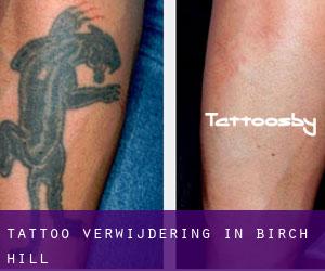 Tattoo verwijdering in Birch Hill