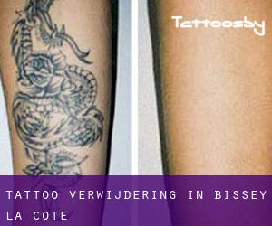 Tattoo verwijdering in Bissey-la-Côte