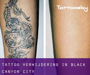 Tattoo verwijdering in Black Canyon City