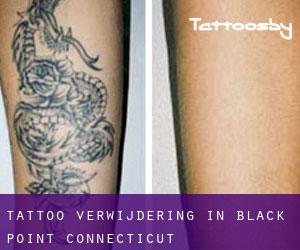 Tattoo verwijdering in Black Point (Connecticut)