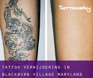 Tattoo verwijdering in Blackburn Village (Maryland)
