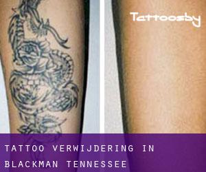Tattoo verwijdering in Blackman (Tennessee)