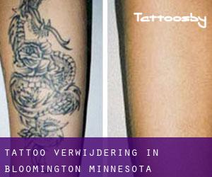 Tattoo verwijdering in Bloomington (Minnesota)