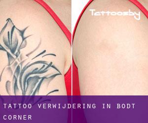 Tattoo verwijdering in Bodt Corner