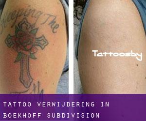 Tattoo verwijdering in Boekhoff Subdivision
