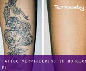 Tattoo verwijdering in Bohodón (El)