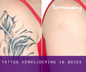 Tattoo verwijdering in Boies