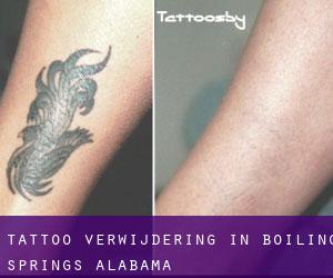 Tattoo verwijdering in Boiling Springs (Alabama)