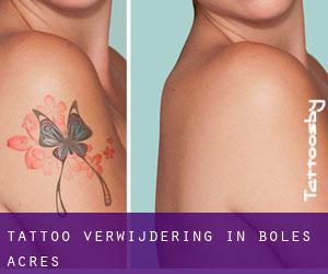 Tattoo verwijdering in Boles Acres