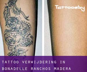 Tattoo verwijdering in Bonadelle Ranchos-Madera Ranchos
