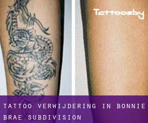Tattoo verwijdering in Bonnie Brae Subdivision