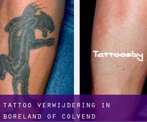 Tattoo verwijdering in Boreland of Colvend