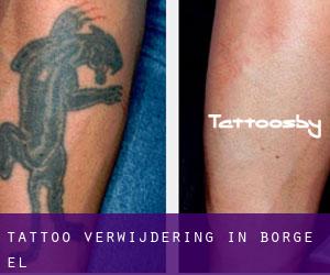 Tattoo verwijdering in Borge (El)