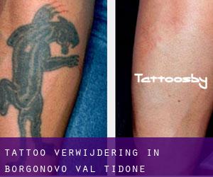 Tattoo verwijdering in Borgonovo Val Tidone
