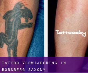 Tattoo verwijdering in Borsberg (Saxony)